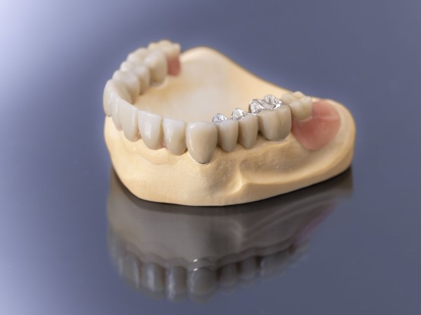 Eine Unterkieferprothese auf einem Gipsmodell